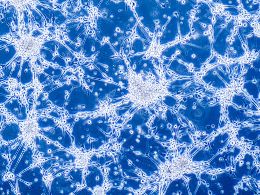 La eficacia de las células madre para tratar un agresivo cáncer cerebral